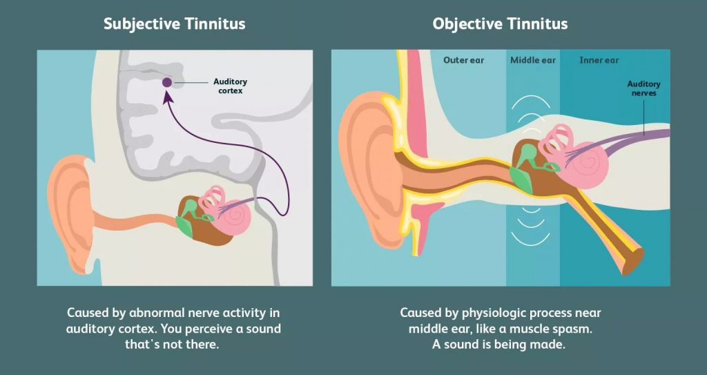 le bruit dans les oreilles connu sous le nom d'acouphène