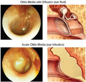 tympan d'une oreille avec otite moyenne séreuse
