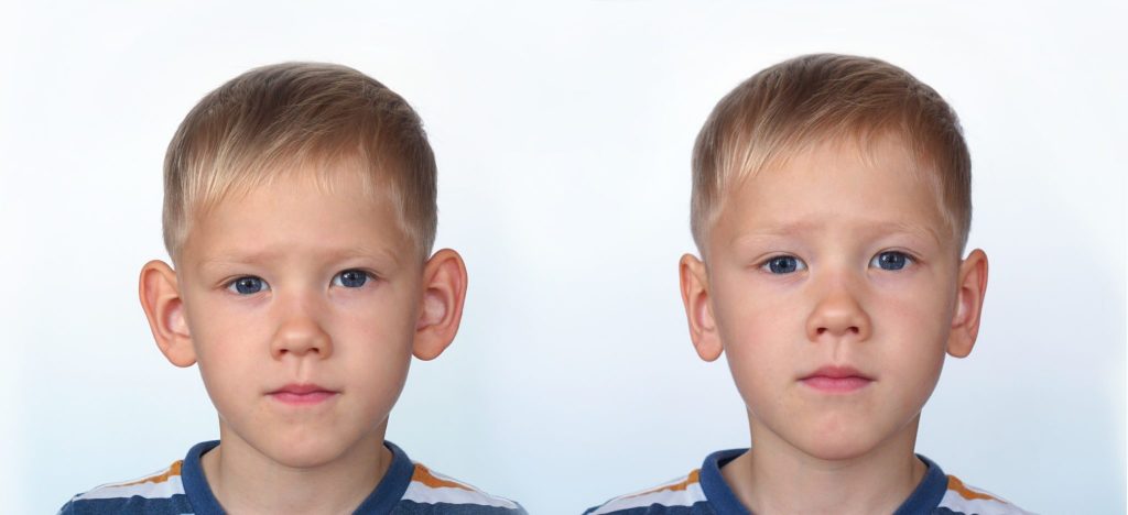 orl pediatrique pour enfant avec les oreilles decollees