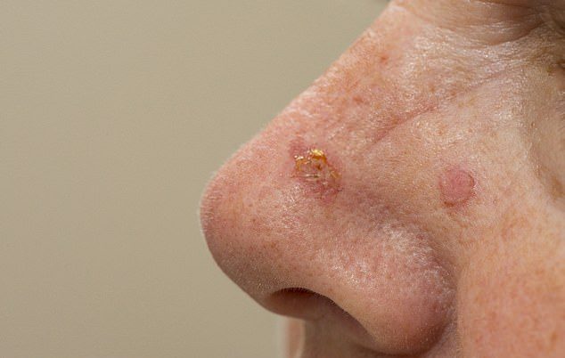 nasal skin lesions