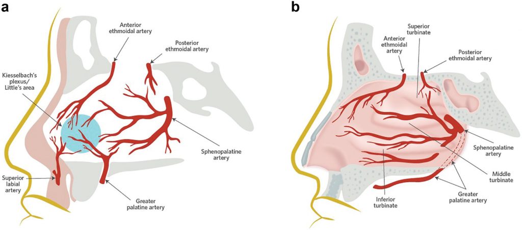 Areas of bleeding